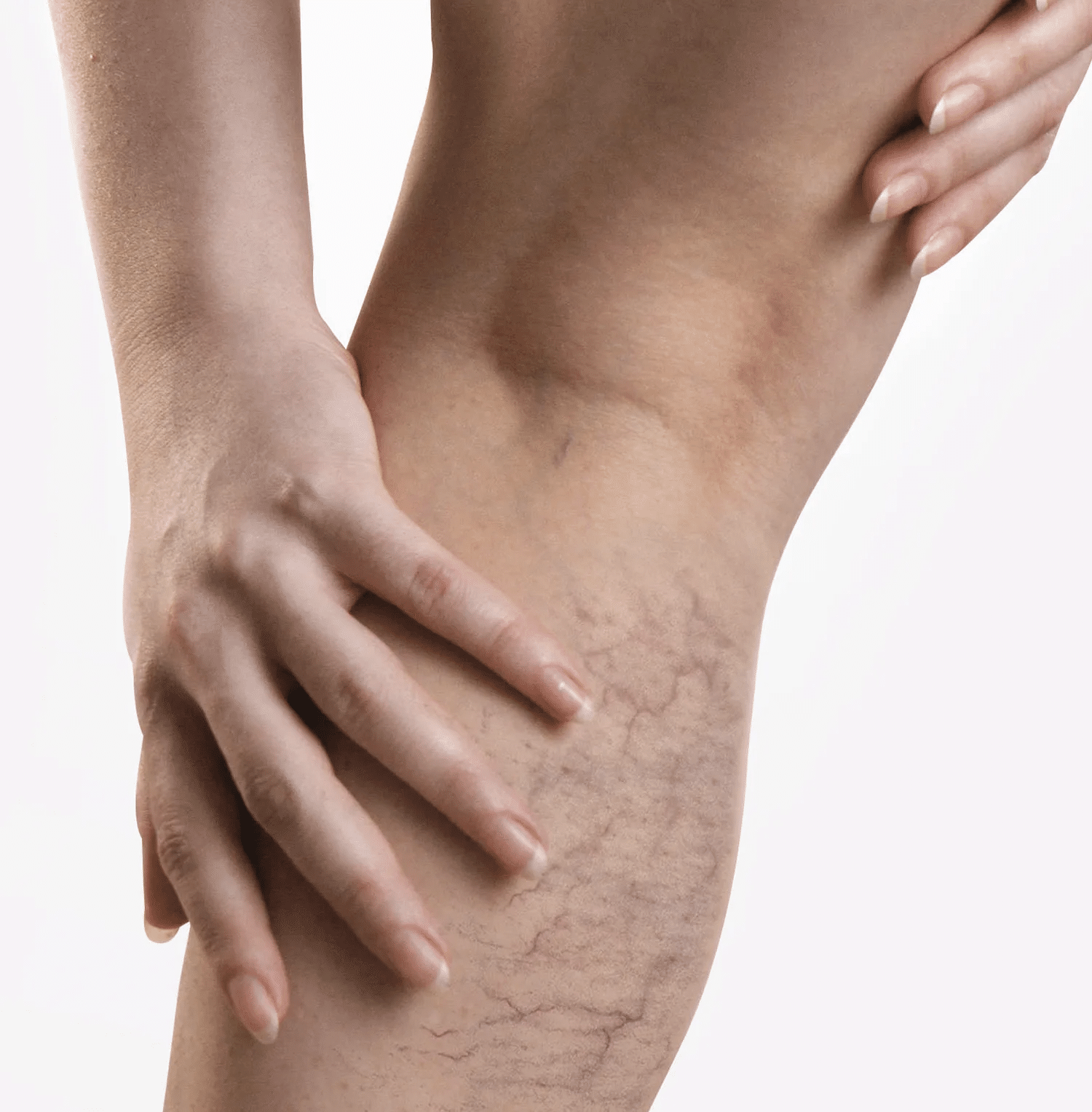 vipcenters_SpidersVeinsmobile_treatment_img1